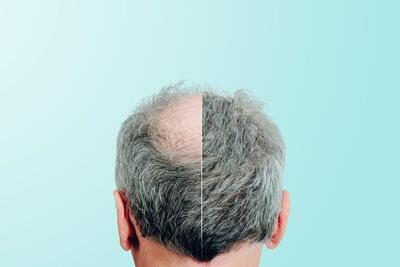  پژوهش جدید: امید تازه به درمان طاسی مو