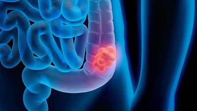 هشدار در مورد ابتلا به بیماری خاموش سرطان روده بزرگ