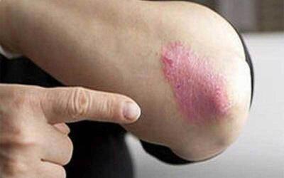  کاهش ۳۰ درصدی خطر پسوریازیس با یک عادت ساده در سبک زندگی
