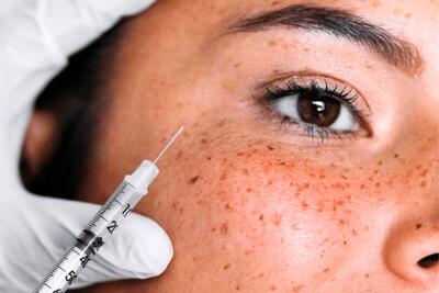 درمان پی آر اف PRF چگونه باعث جوانسازی پوست می‌شود؟