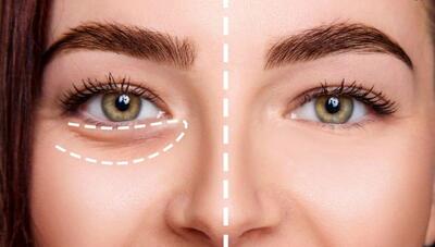 درمان سریع گودی زیر چشم با PRF چگونه انجام می‌شود؟