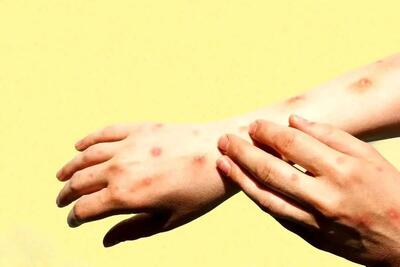  شناسایی هزار و ۱۰۷ بیمار مبتلا به تب دنگی در کشور / کدام استان‌ها درگیر این بیماری هستند؟