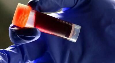 گروه خونی که بیشتر از همه سکته مغزی می‌کند!