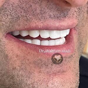 ایمپلنت دیجیتال بهتره یا معمولی؟ مقایسه مزایا، معایب و هزینه‌ها