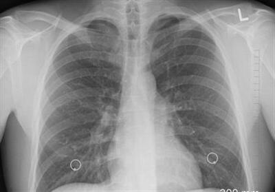 افزایش نگران‌کننده سرطان ریه در گلستان/ تریاک خطر ابتلا را 3.6 برابر افزایش می‌دهد - تسنیم