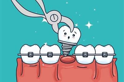 آیا دندان ایمپلنت شده را میتوان ارتودنسی کرد؟