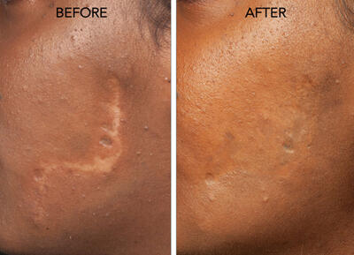 مقایسه درمان جای زخم با سلول‌های بنیادی و لیزر؛ کدام مؤثرتر است؟