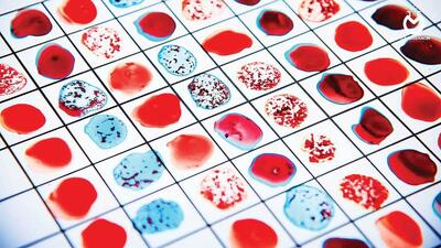 سکته مغزی در کدام گروه خونی رواج بیشتری دارد؟