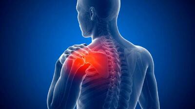 شانه منجمد چیست؟ علل، علائم و بهترین روش های درمان