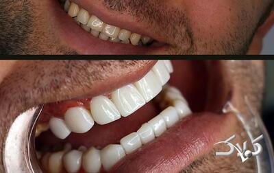 لمینت بهتر است یا کامپوزیت و نکاتی که باید بدانید - مجله اینترنتی کولاک