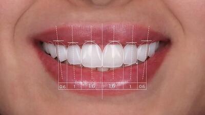 کامپوزیت دندان چیست؟ ( مزایا ، معایب و عوارض + قیمت ) - مردم سالاری آنلاین