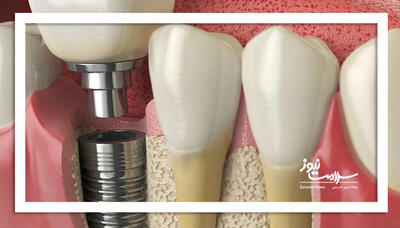 حقایقی درباره ایمپلنت‌های یک روزه