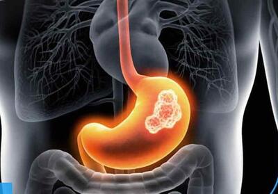 سرطان‌‌های معده و روده بزرگ شایع‌ترین انواع سرطان/ مقاومت وزارت بهداشت در توزیع کیت‌های غربالگری در داروخانه‌ها - تسنیم