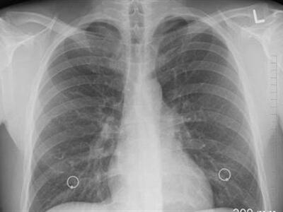 افزایش نگران‌کننده سرطان ریه در گلستان