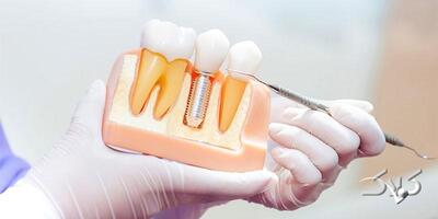 ایمپلنت اقساطی دندان با بهترین مواد و متخصص در شهریار - مجله اینترنتی کولاک