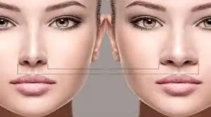 آیا جراحی بینی گوشتی برگشت پذیر است؟