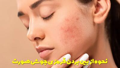  نحوه از بین بردن قرمزی جوش صورت به روش خانگی و سریع و فوری