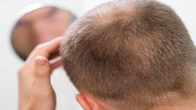  بررسی قدم به قدم مراحل کاشت مو | اندیشه قرن