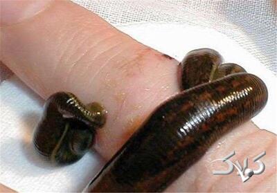 کمک به بیماران پسوریازیس با «زالو درمانی»؛ معجزه ای دیگر از طب سنتی - مجله اینترنتی کولاک