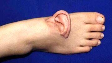 نجات لاله گوش زن جوان با پیوند موقت روی پا