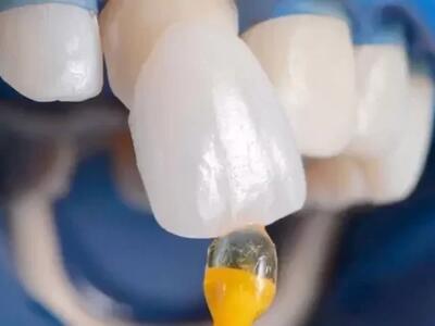 آیا چسباندن دندان با چسب ۱۲۳ امکان پذیر است؟