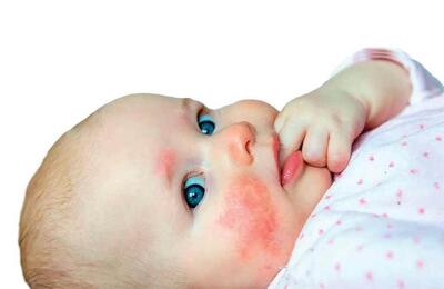 ۶ عارضه پوستی شایع در نوزادان