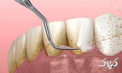 طبیعی‌ترین جرم گیر فوری دندان | سیاه ولیک ؛ بهترین جرم گیر دندان خانگی را بشناسید - مجله اینترنتی کولاک
