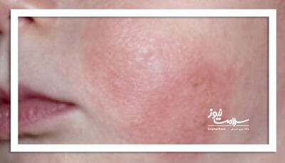 احتمال ابتلای نوزادن به این عوارض پوستی وجود دارد