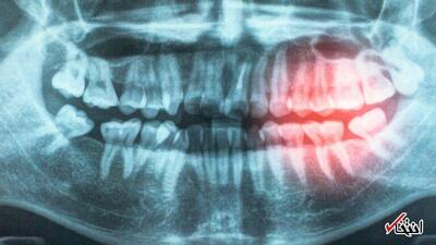  ارتباط بیماری لثه با افزایش خطر بیماری‌های قلبی