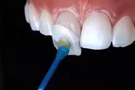  چسباندن روکش دندان با چسب قطره ای