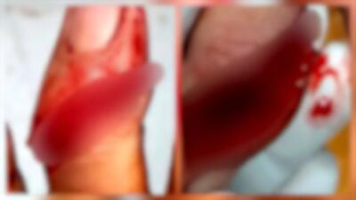 قطع 2 انگشت کارگر حراست در درگیری خونین با سارقان در هفت‌تپه