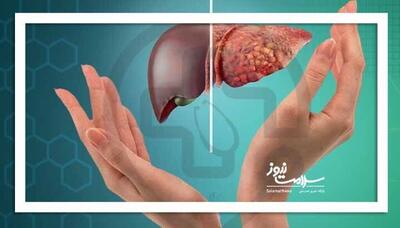  کبد چرب؛ بیماری خاموش قرن کم‌تحرکی