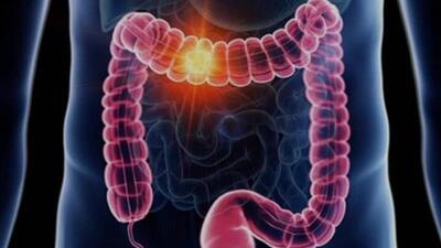 علائم گوارشی را ساده نگیرید؛ هر خون‌ریزی هموروئید نیست