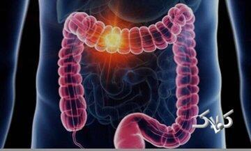 علائم گوارشی را ساده نگیرید/ هر خون‌ریزی هموروئید نیست - مجله اینترنتی کولاک