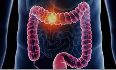 علائم گوارشی را ساده نگیرید