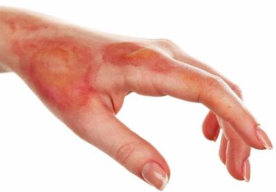 بیش از 50 درصد سوختگی‌ها قابل کنترل و درمان است - تسنیم