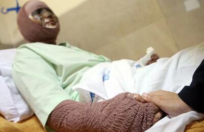 زنگ خطر سوختگی در ایران؛ سالانه ۳۰۰ هزار مصدوم، ۸ برابر میانگین جهانی