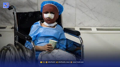 نرخ سوختگی در ایران ۸ برابر میانگین جهان