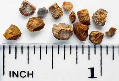 عوارض خطرناک مصرف این مسکن با کافئین برای کلیه ها