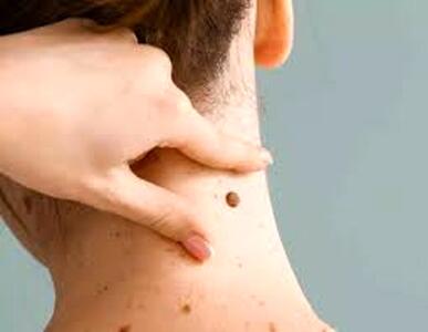 هزینه برداشتن خال گوشتی در سال 1404 چقدر است؟