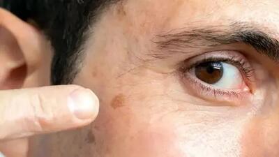 «آلودگی هوا فقط ریه‌ها را نمی‌زند؛ پوست هم قربانی خاموش دود و ذرات معلق»