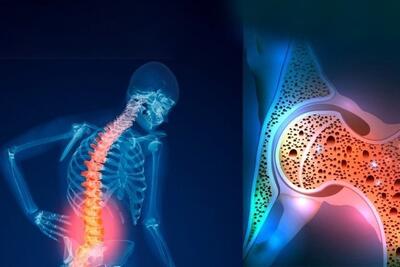 پوکی استخوان؛ بیماری خاموشی که تا شکستگی نشانه‌ای ندارد