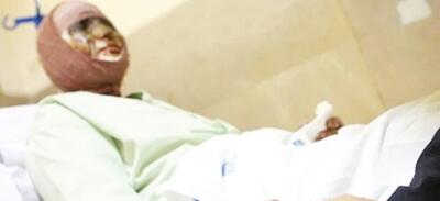 زنگ خطر سوختگی در ایران؛ سالانه ۳۰۰ هزار مصدوم، ۸  برابر میانگین جهانی