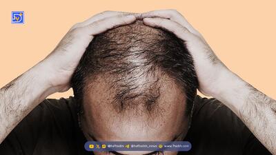  کمبود کدام ویتامین باعث ریزش مو می شود؟