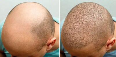  کاشت مو در مشهد | انتخاب آگاهانه برای نتیجه طبیعی و ماندگار