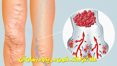  علائم لخته خون در پا و درمان آن | آیا باعث مرگ میشود؟ + علت لخته شدن خون در پا