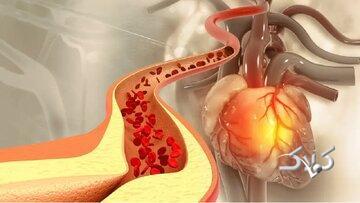 کاهش کلسترول، بدون نیاز به دارو/ چربی‌های کاهنده کلسترول کدامند؟/ این ورزش‌ها موثرند - مجله اینترنتی کولاک