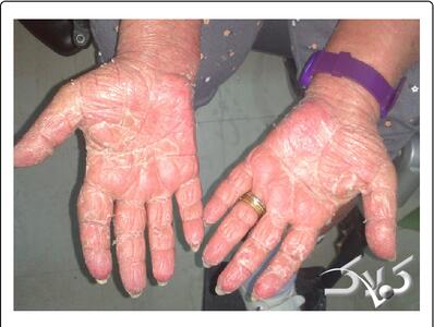 سندرم DRESS چیست؟ - روزیاتو - مجله اینترنتی کولاک