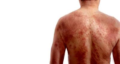 بیماری ترانه علیدوستی چیست و چه علائمی دارد؟