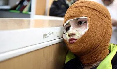 میزان سوختگی در ایران ۸ برابر میانگین جهانی/۳۰۰۰ نفر جان خود را از دست می‌دهند